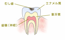 C1:エナメル質の虫歯