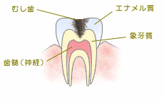 C2:象牙質の虫歯