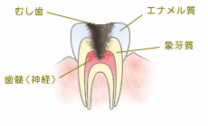 C3:神経の虫歯