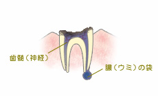 C4:歯根の虫歯