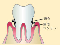 第二段階（歯周炎第1～2度）