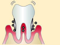 最終段階（歯周炎第3～4度）
